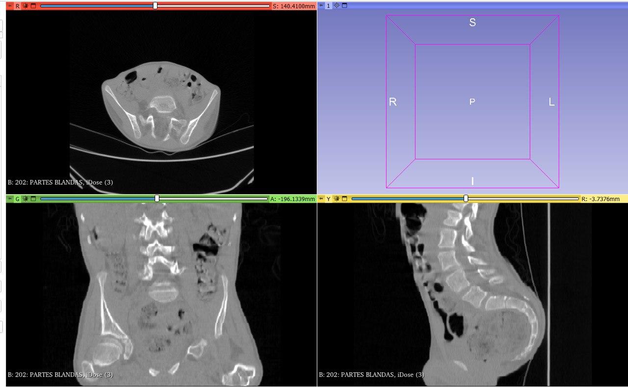 3D Printing in Medicine: Dislocated Hip 3D Printing and Modelling