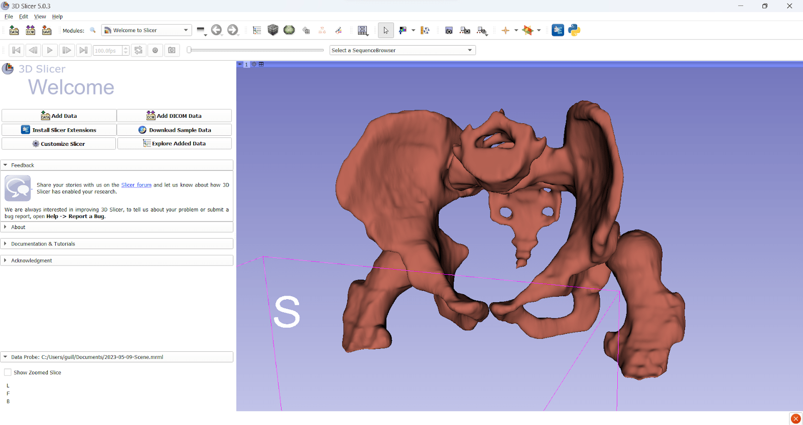 3D Printing in Medicine: Modelling and 3D Printing of Dislocated Hip 4