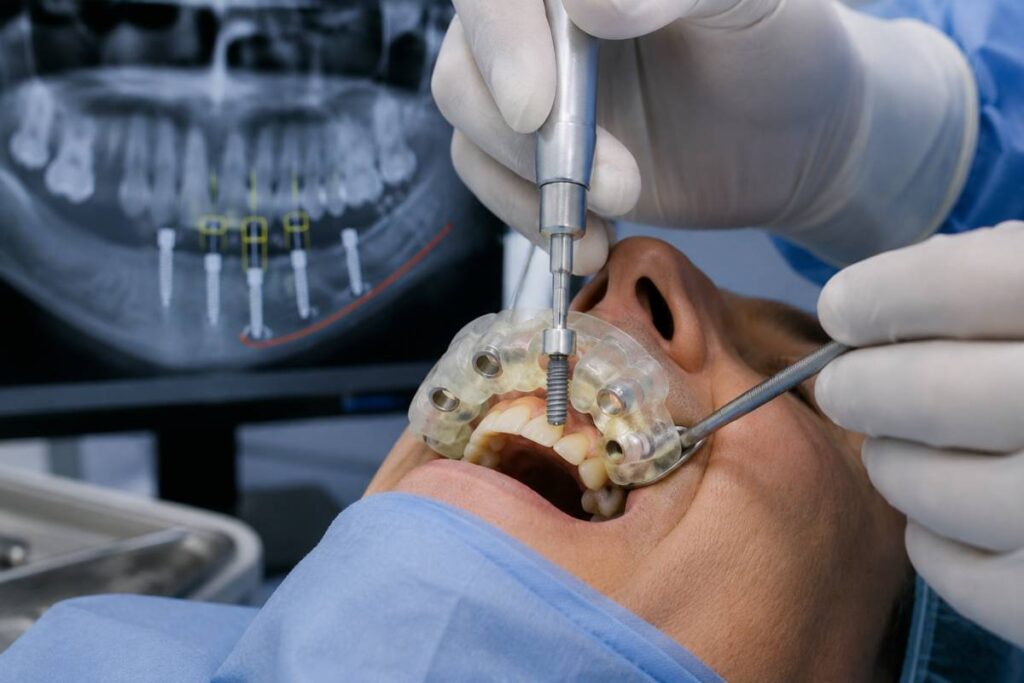 implantes dentales con impresion 3d